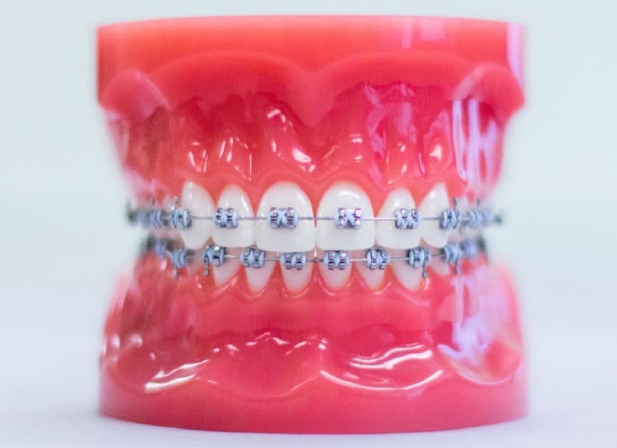 metal braces on plastic model