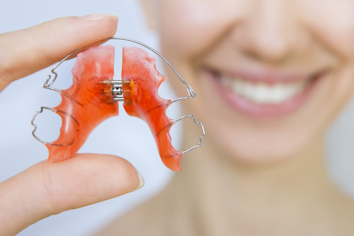 What You Need to Know About Palatal Expanders